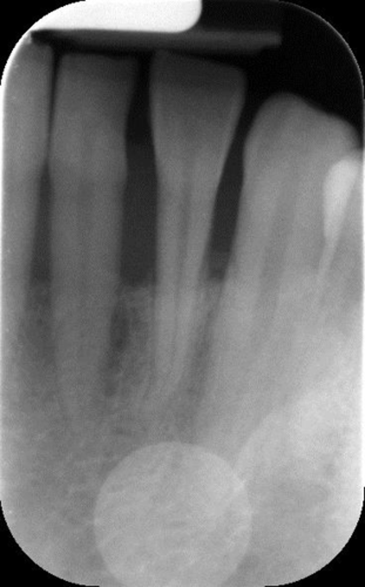 <p>ā¢Improper placement of wrapped plate in the mouth</p><p>ā¢Improper wrapping of the plate in dispensary</p><p>It is your responsibility to verify that the plate has been correctly wrapped</p><p>X rays must hit the plate on the blue side</p>