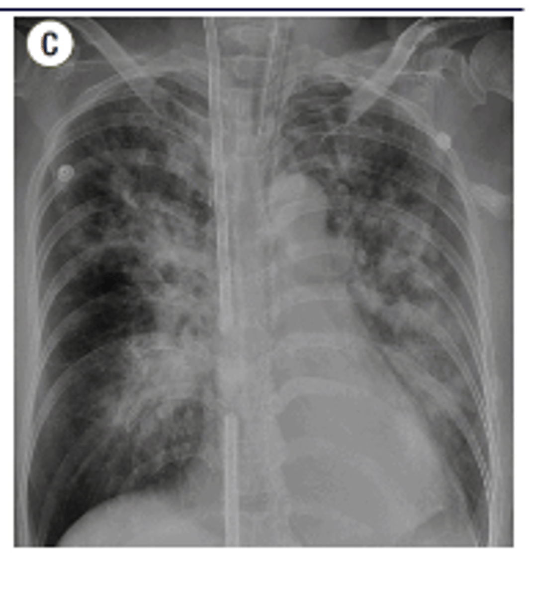 <p>Gastric contents or other bodily fluids can be aspirated into the lungs</p><p>patchy, alveolar infiltrate</p>