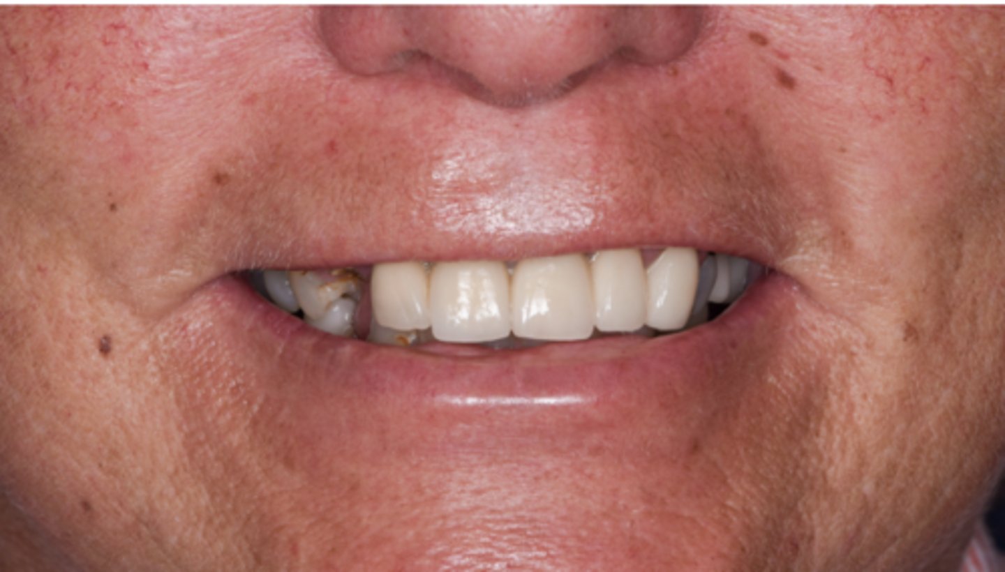 <p>Provided figure showed 80% exposure of the anterior teeth when the patient smile. Please select correct answer ? (select one)</p><p>A. High smile line</p><p>B. Gammy smile</p><p>C. Average smile line</p><p>D. Lowe smile line</p>