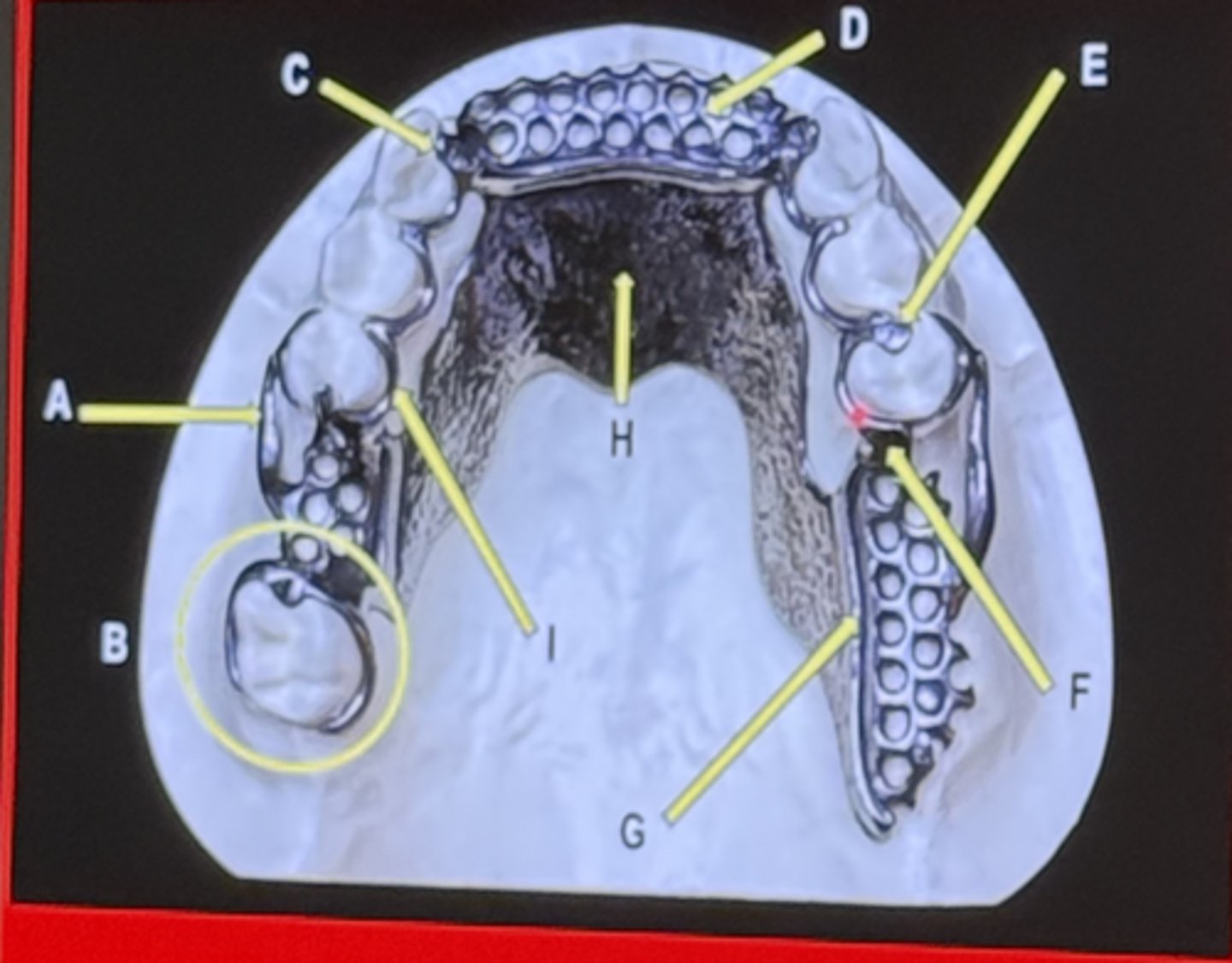 <p>guie plate, indirect retainer, m/c rest</p>