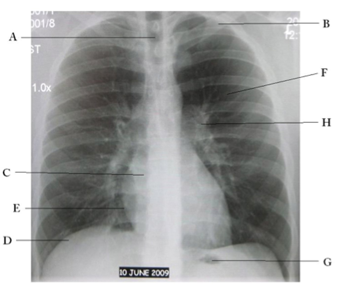 <p>left upper lobe</p>