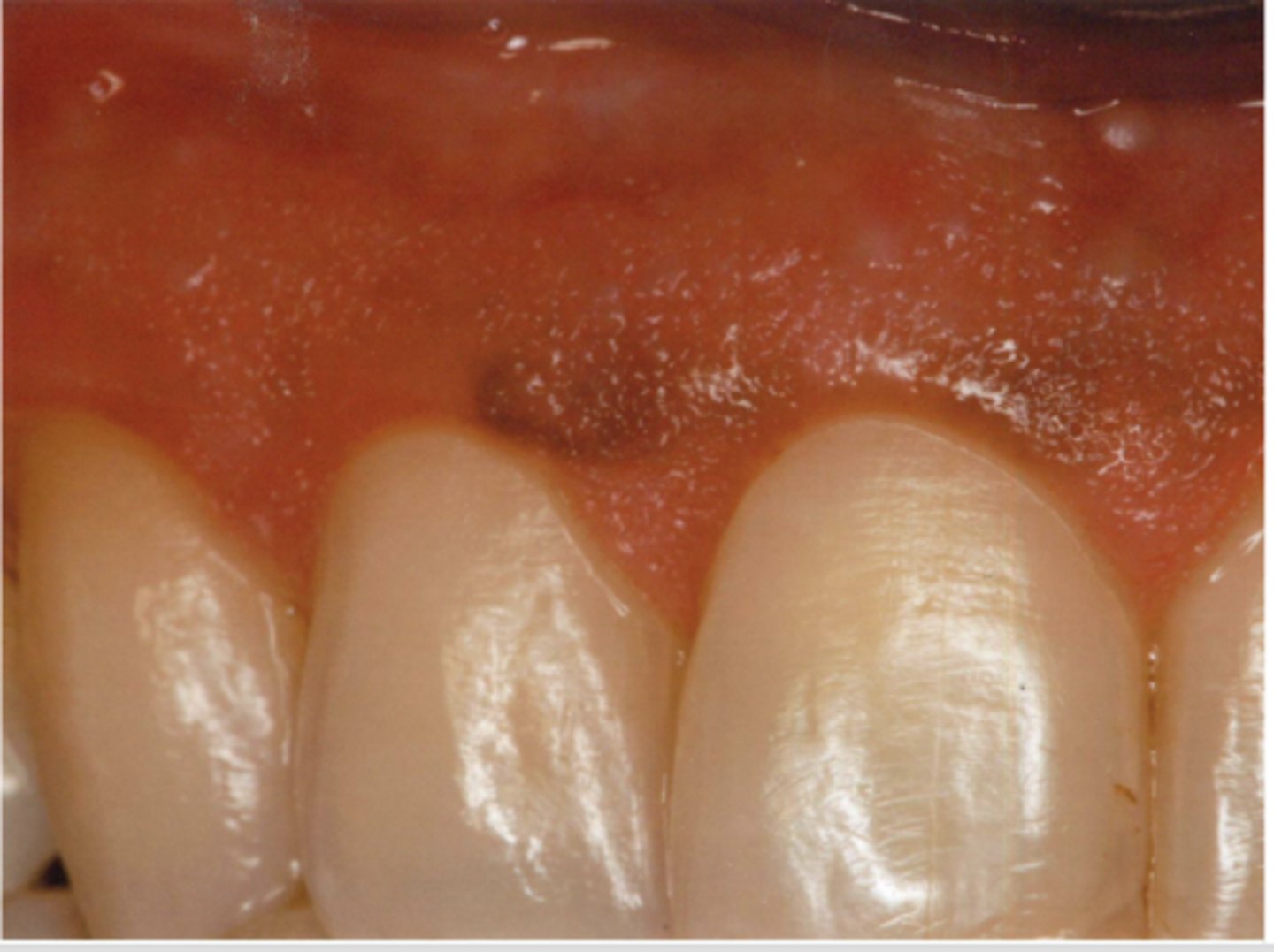 <p>Patient is a smoker. What type of pigmented lesion?</p>