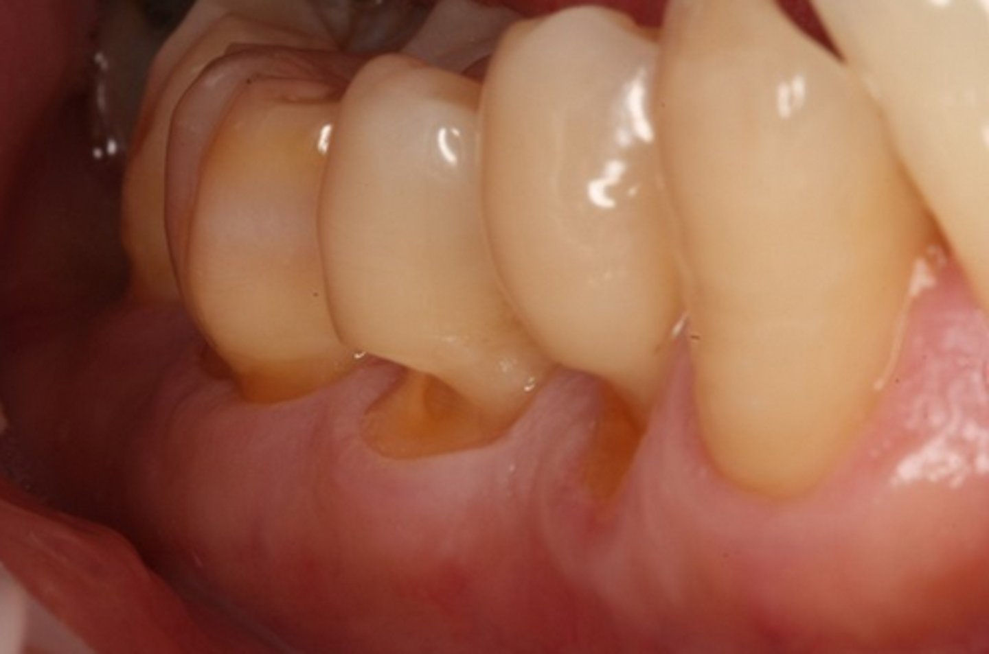 <p>Condition that results in "V" shaped notches in the cervical third of the tooth often caused by occlusal forces.</p>