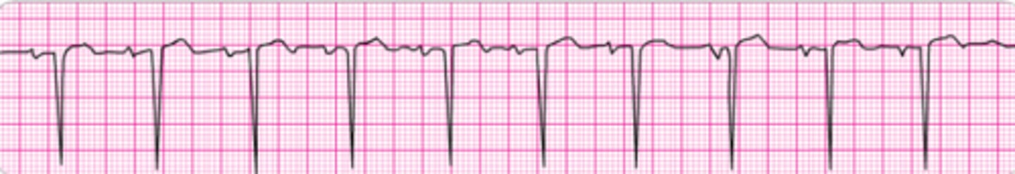 <p>Identify the rhythm.</p>