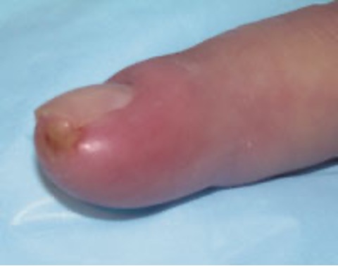 <p>acute infx of fingertip pulp space</p>