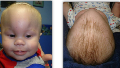 <ul><li><p>ridged ossification of metopic suture </p></li><li><p>midline frontal bossing </p></li><li><p>bitemporal narrowing </p></li><li><p>trigonalcephaly - triangular shape of the head </p></li></ul><p></p>
