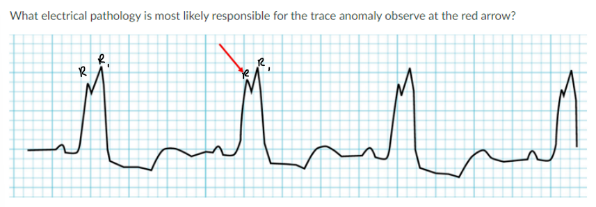 <p>JONES IN CLASS ASSIGNMENT QUESTIONS:</p><p>a. Torsades de pointes</p><p>b. PVC</p><p>c. Ventricular fibrillation</p><p>d. bundle branch block</p>