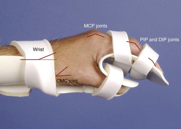 <p>Wrist- neutral to 30 degrees extension, Normal transverse and longitudinal arches, moderate tendon shortening for tenodesis, Thumb- abducted and opposed, preservation of web space </p>