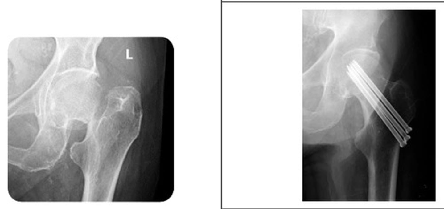 <p>What type of hip pinning is shown?</p>