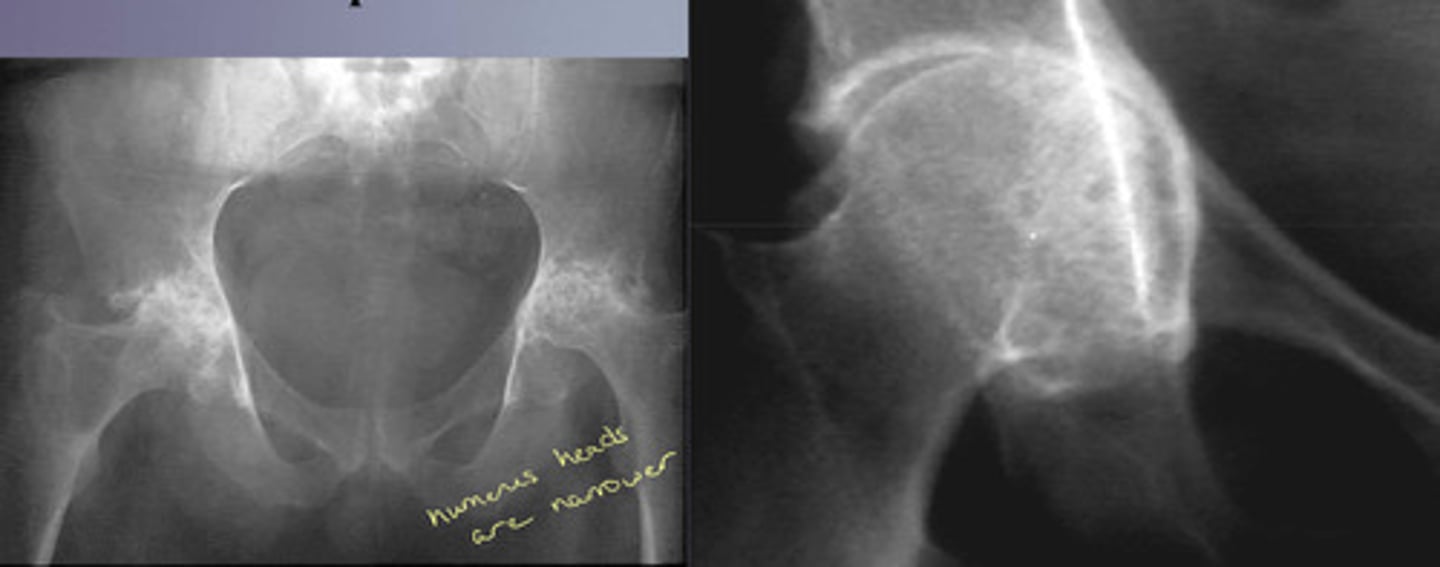 <p>Axial migration or acetabular protrusion</p>