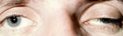<p>Abnormalities of the External Eye</p><ul><li><p>Drooping eye</p></li></ul><p></p>