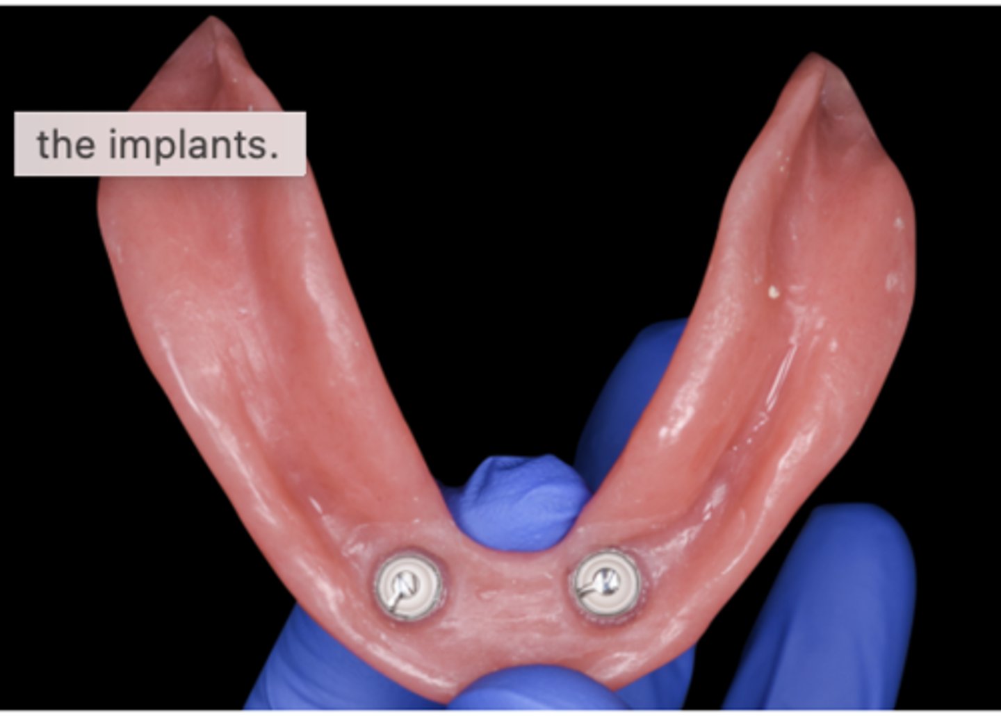 <p>In the case shown, support for the overdenture comes from:</p><p>A. the implants</p><p>B. No answer text provided.</p><p>C. both the implants and soft tissues</p><p>D. soft tissues</p>