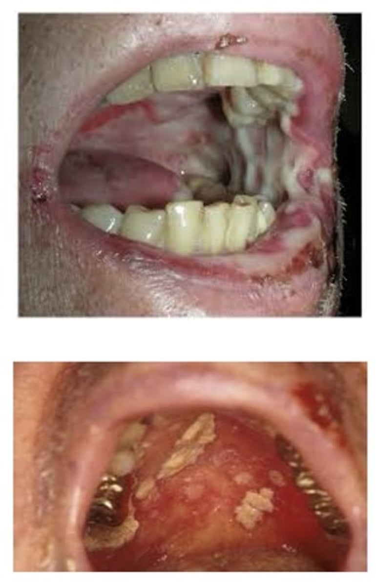 <p>This condition begins about the second week of radiation therapy and subsides a few weeks after its completion. Painful. Appears as erythematous and ulcerated mucosa. The patients may have difficulty eating, pain on swallowing, and loss of taste.</p>