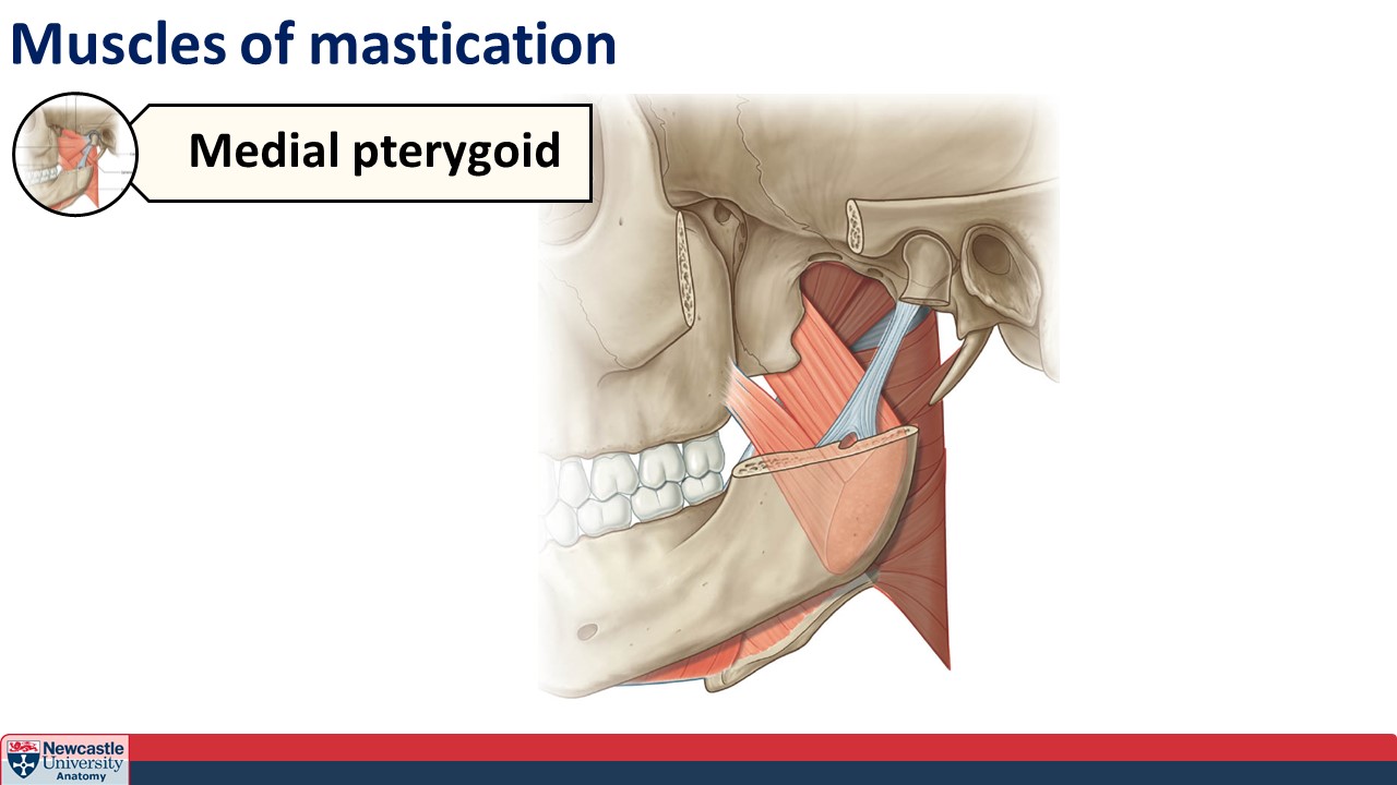 <p>Medial pterygoid</p>