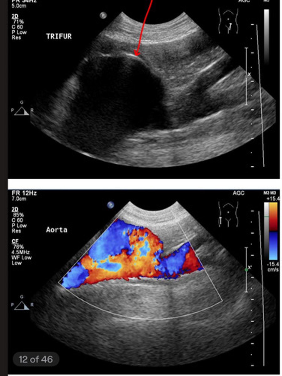 <p>what is the abnormality in this aorta indicated by the red?</p>