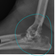 <p>Synovial cell sarcoma </p>