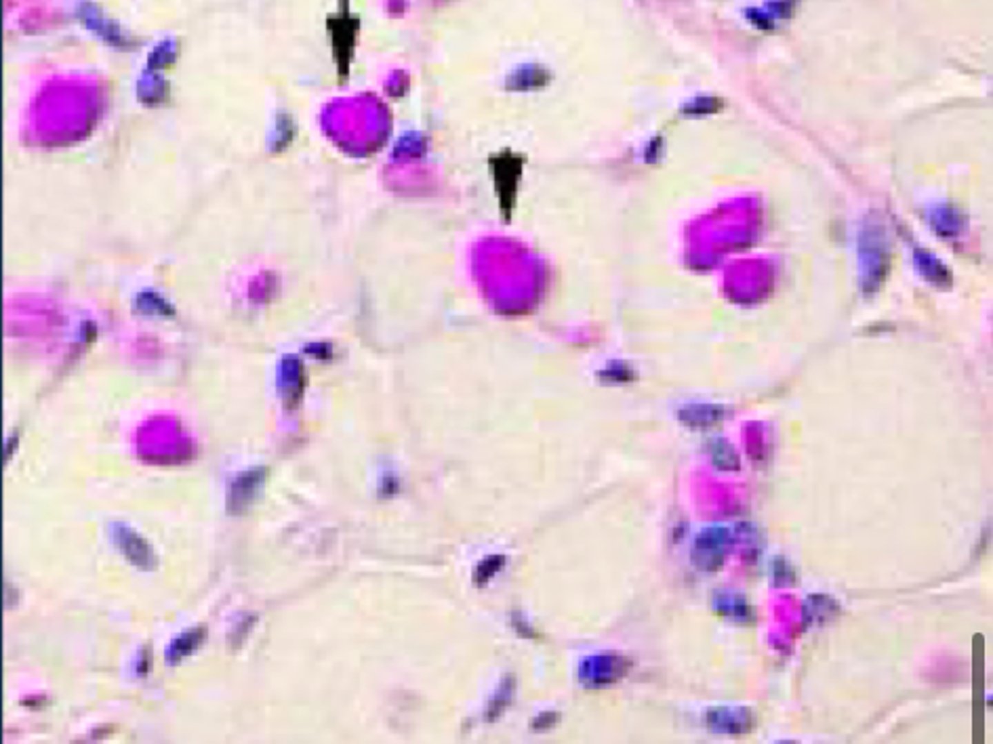 <p>What does a Glyogen branching enzyme deficiency going to do?</p>