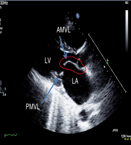 <p>mitral valve</p>