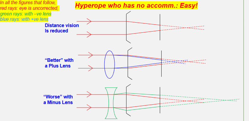 <p>hyperopes who have no accom </p>
