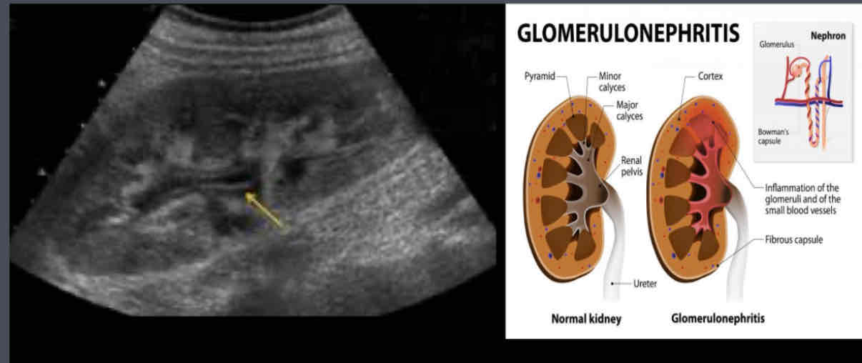 <p><span>What is an Inflammation of glomeruli, caused by infection, autoimmune response, medications, toxins (can be acute or chronic)?</span></p>