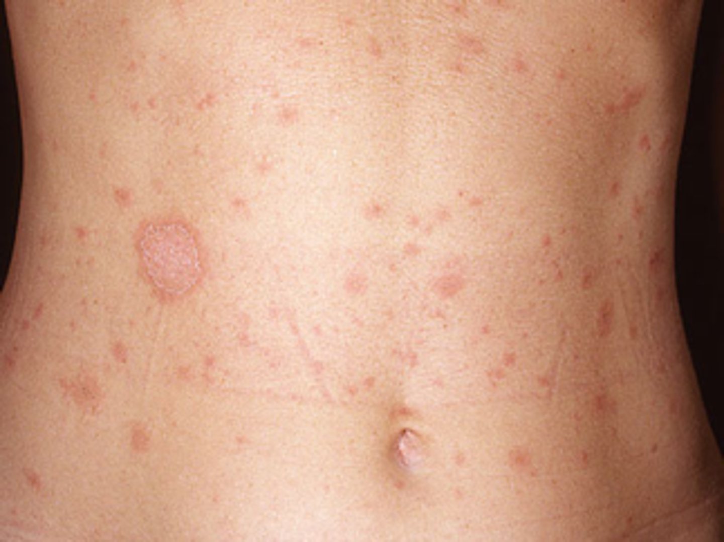 <p>Pityriasis Rosea (followed by "Christmas Tree" rash on back)</p>