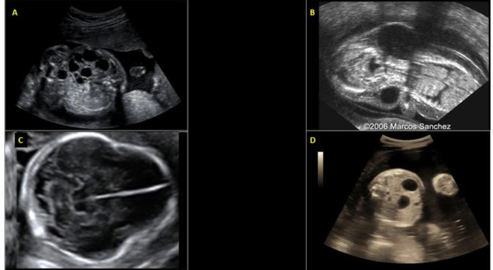 <p>trisomy 21 is suspected. which image is suggestive of this?</p><p>a) A </p><p>b) B</p><p>c) C</p><p>d) D</p>