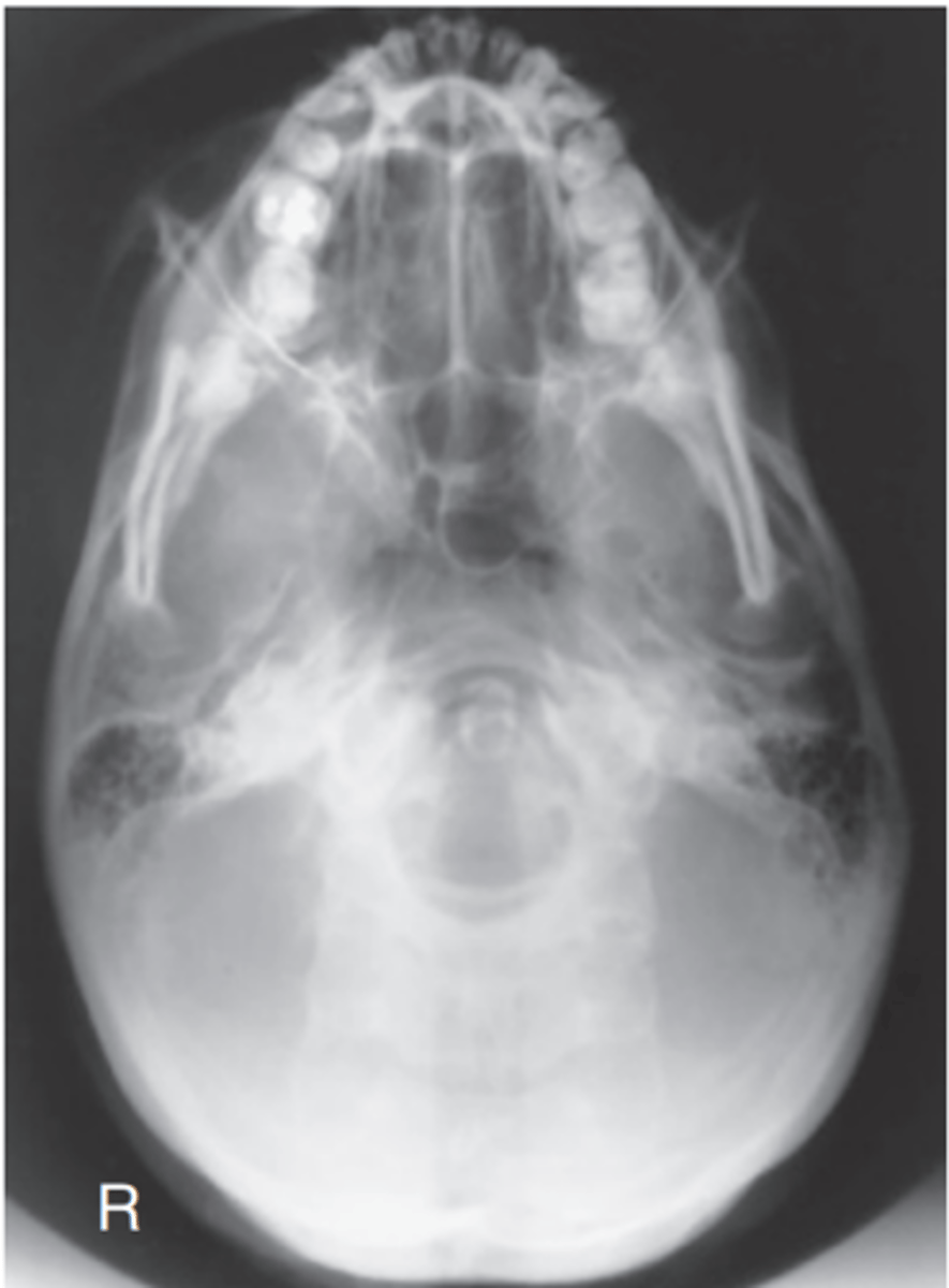 <p>-Position:</p><p>• Correct extension of neck and relationship between IOML and CR as indicated by mandibular mentum anterior to the ethmoid sinuses.</p><p>• No rotation evidenced by the MSP parallel to edge of IR.</p><p>• No tilt evidenced by equal distance between mandibular ramus and lateral cranial cortex.</p>