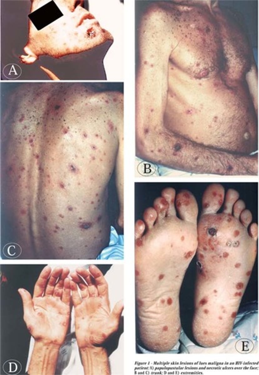 <p>Secondary Syphilis (T. Pallidum)</p>