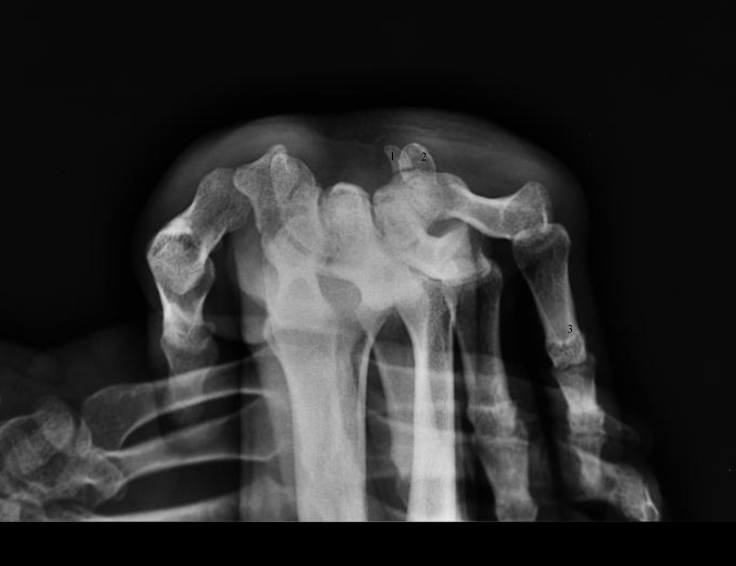 <p>What is the injury in this radiograph?</p>