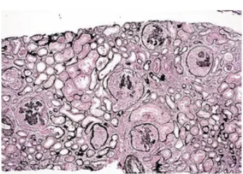<p><strong>Nefritis Lúpica de clase IV</strong></p><ul><li><p>Forma <strong>más frecuente</strong> y grave</p></li><li><p>Lesiones similares a las de clase 3, pero la afectación es <span style="color: red;"><strong>difusa </strong>osea &gt;50% de los glomérulos afectados</span></p></li><li><p>Lesiones pueden ser segmentarias (IV-S) o globales (IV-G)</p></li><li><p>Proliferación de células endoteliales, mesangiales y epitelilales</p><ul><li><p>se pueden formar semilunas es espacio de Bowman</p></li></ul></li><li><p>Engrosamiento de la pared capilar a forma de “asa de alambre“ en microscopía óptica</p></li><li><p>Hay inmunocomplejos por inmunofluorescencia</p></li></ul><p></p><p>Presentación clínica</p><ul><li><p>Hematuria y proteinuria</p></li><li><p>Cilindros eritrocitarios</p></li><li><p>Concentración elevada de anticuerpos anti-ADN</p></li><li><p>Complemento sérico reducido</p></li><li><p>Hipertensión&nbsp;</p></li></ul><p></p>