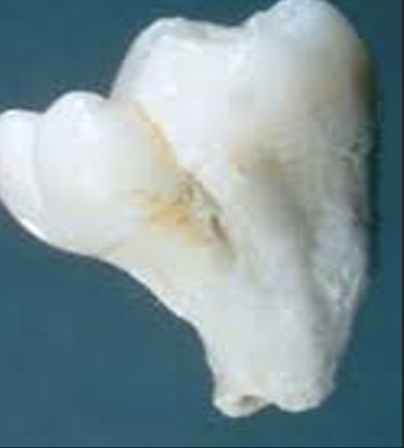 <p>Hierbij is er een dubbele tand, maar heeft 1 wortel. Er lijken hierbij dus 2 kronen te zijn terwijl er maar 1 radix, 1 pulpakamer en 1 wortel is.&nbsp;</p>