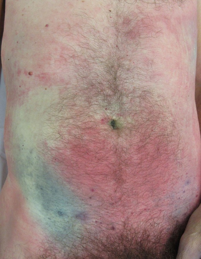 <p>Decomposition discoloration </p>