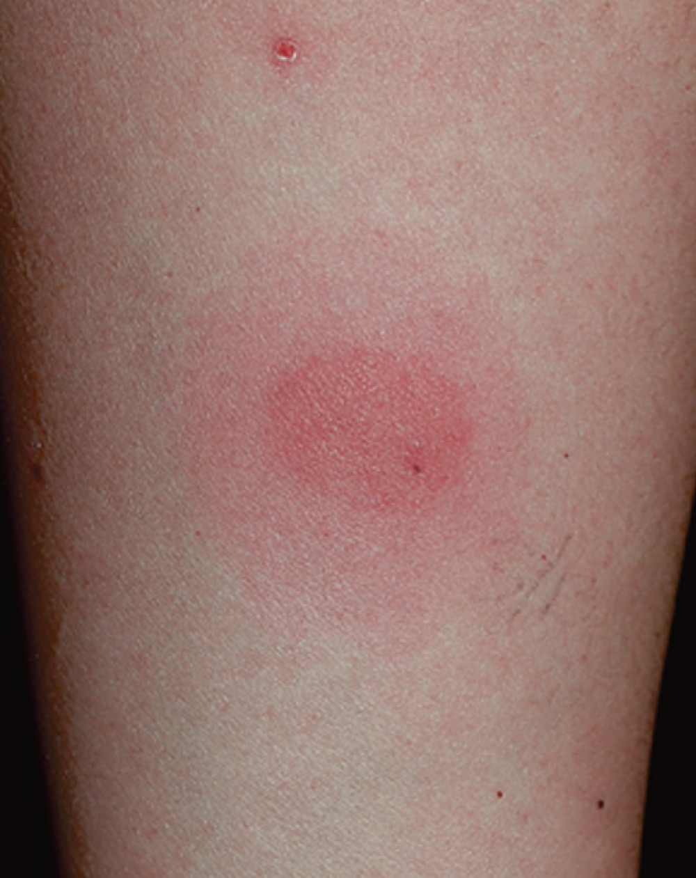 \
What is this called?

A. A Bull’s eye lesion 

B. A laceration 

C. A positive tuberculin skin test 

D. A birthmark