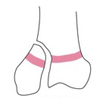 <p>Name this fracture</p>