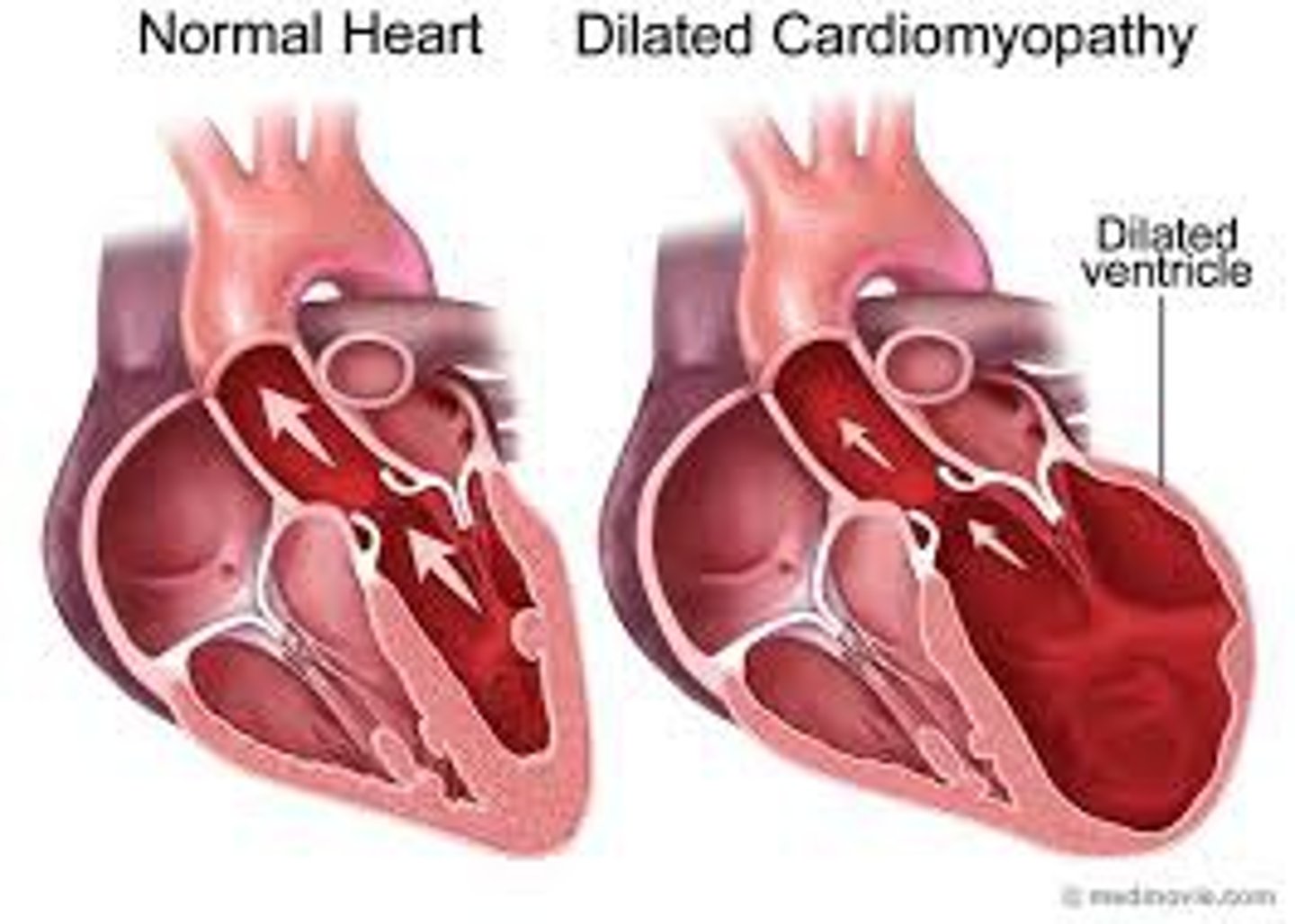 <p>Myocardium stretches and becomes thinner and less elastic</p><p>Results from increased preload</p>
