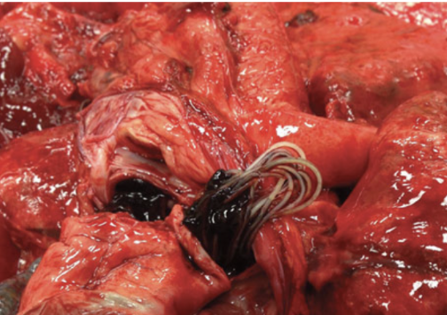 <ul><li><p>Large number of Dirofilaria immitis worms push through right atrium into vena cava → obstruction of blood flow and interferes with tricuspid valve</p></li><li><p>Hemolysis of blood that does pass through</p></li><li><p>Causes liver failure</p></li><li><p>Fatal if not surgically removed</p></li></ul><p></p>