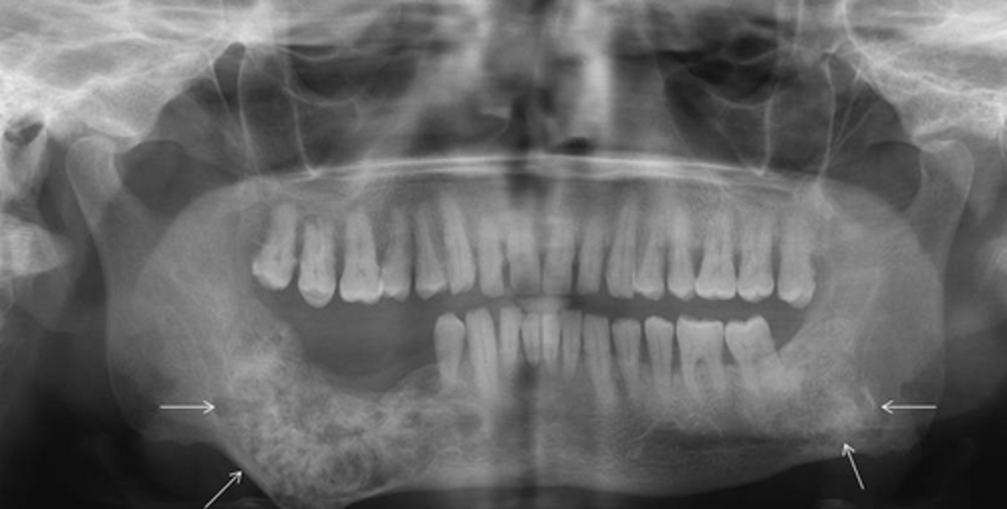 <p>Displaces superiorly</p>