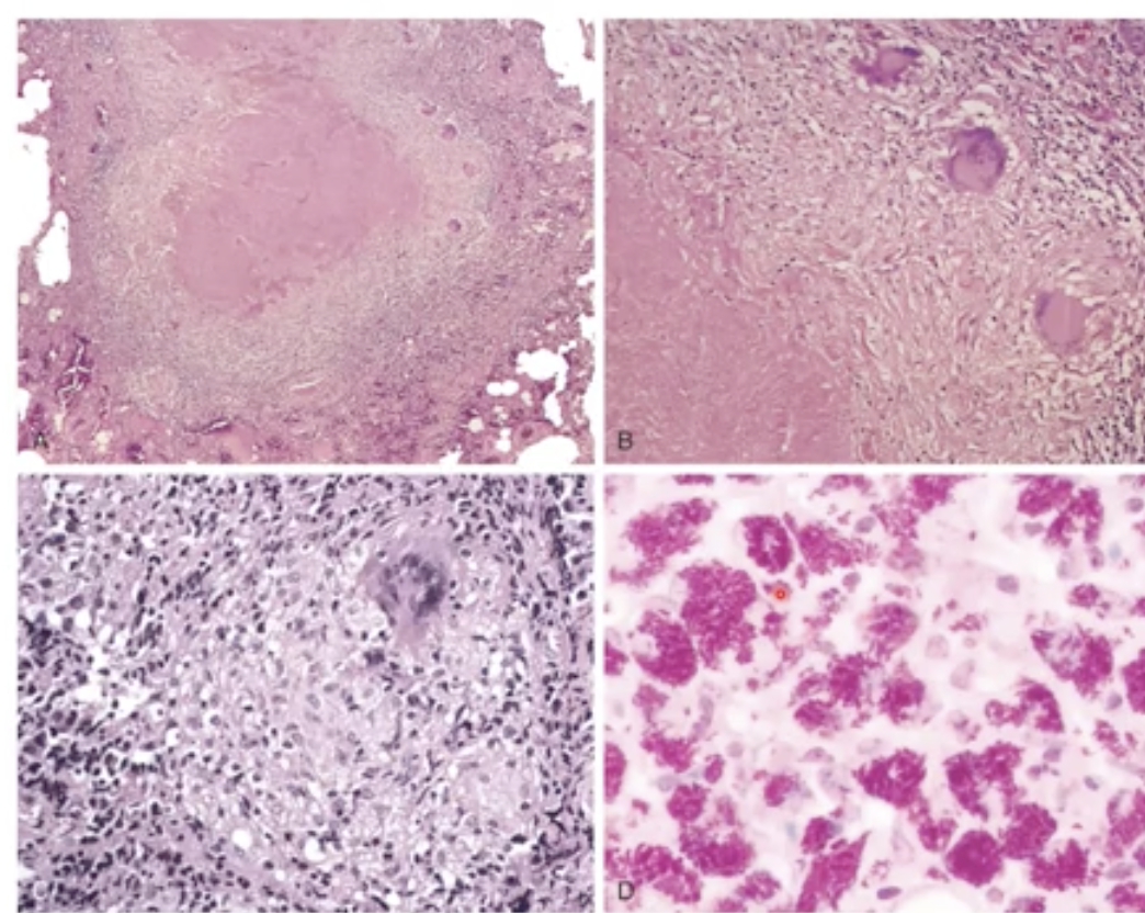 What is the hallmark of tuberculosis ? And where is it shown on the picture 