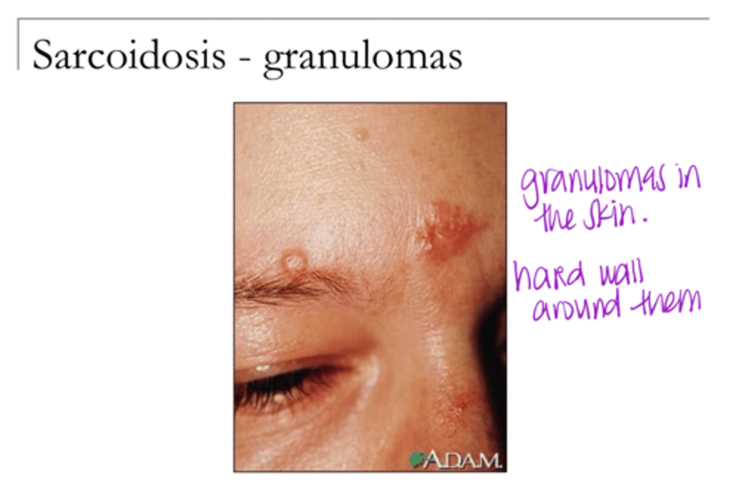 <p>Sarcoidosis -- Granulomas on the Skin (Pic)</p><p>**hard wall around the lesion</p>