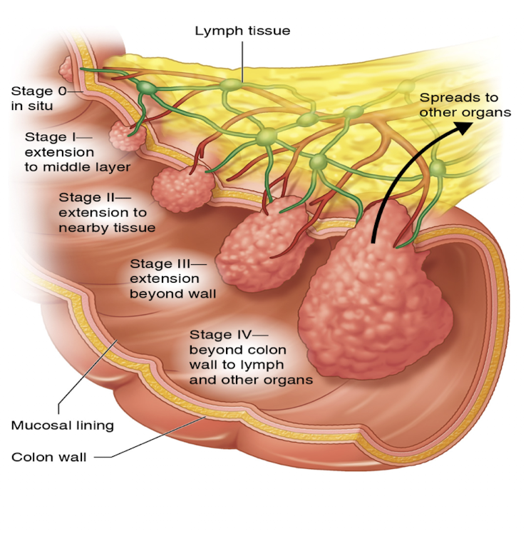 <ul><li><p>Used to determine treatment </p></li><li><p>Usually includes TNM classification</p><ul><li><p>Tumor, lymph nodes, and metastases </p></li></ul></li><li><p>Endoscopy may be used for staging </p></li><li><p>Stage I- extension to middle layer</p></li><li><p>Stage II- extension to nearby tissue </p></li><li><p>Stage III- extension beyond wall</p></li><li><p>Stage IV- beyond colon wall to lymph and other organs </p></li></ul><p></p>