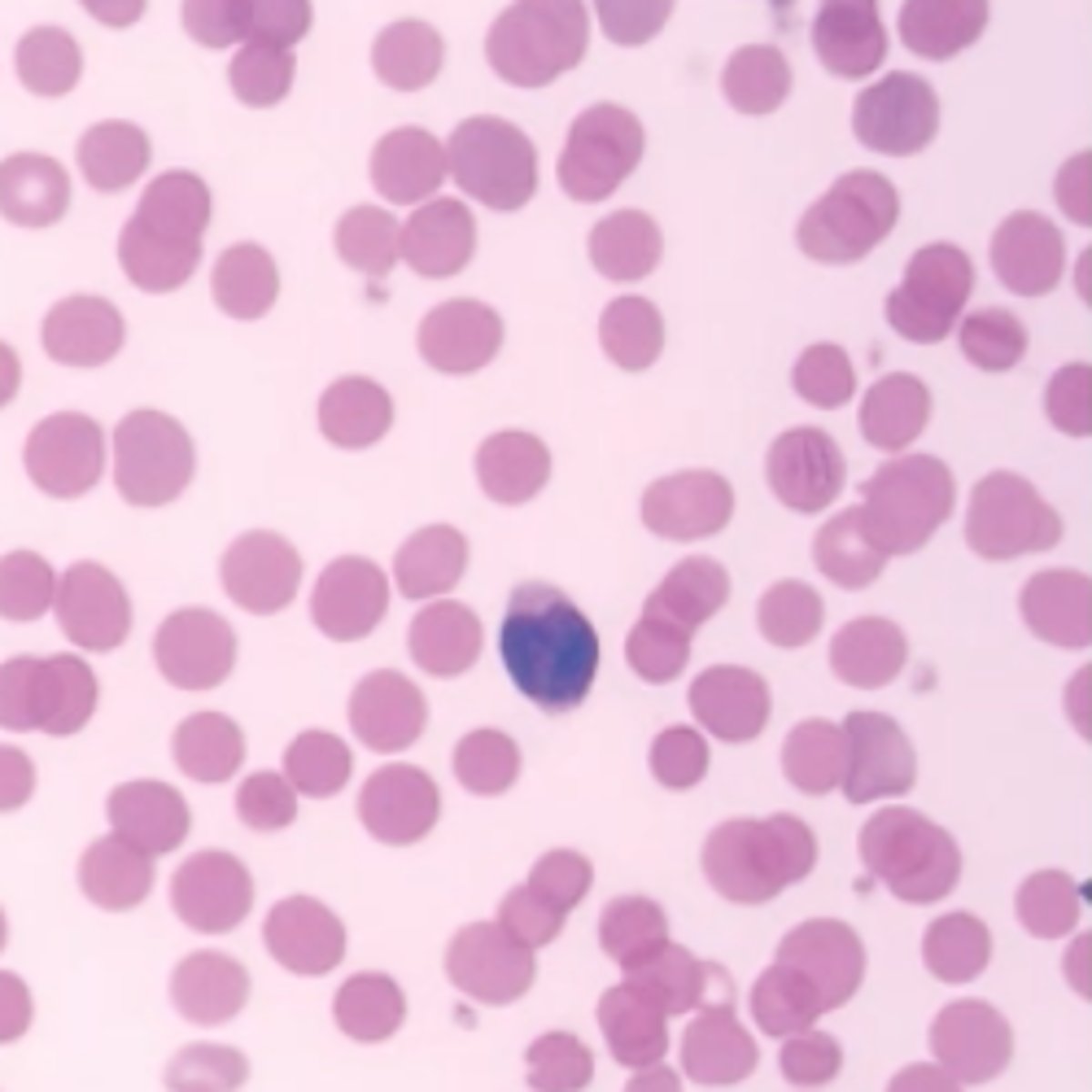 <p>darker than usual (little or no central pallor) </p><p>Loss of cell membrane so a smaller surface area to the same amount of volume from a normal RBC&nbsp;</p>