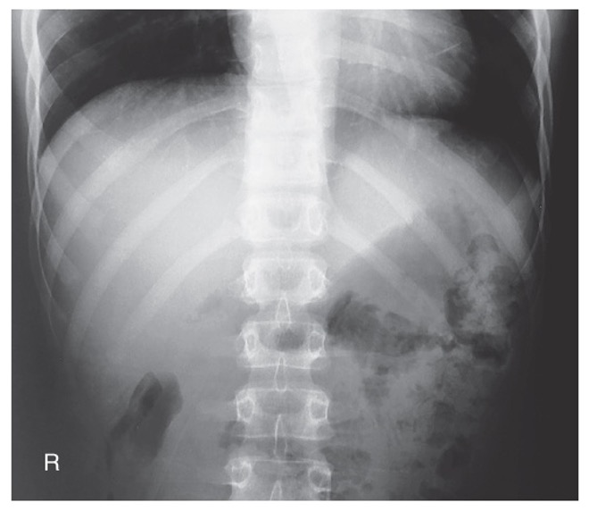 <p><span>10th to 12th ribs visualized below diaphragm</span></p><p><span>No motion</span></p><p><span>No rotation</span></p><p><span>Optimal exposure factors</span></p>