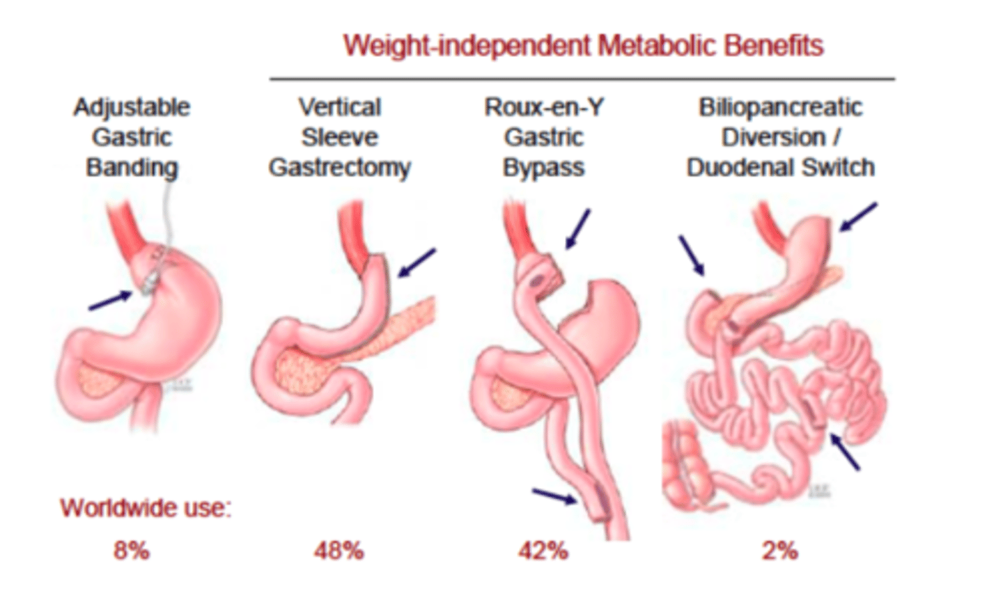 <p>restrictive (reduce size of stomach)</p><p>1. laparoscopic adjustable gastric binding</p><p>2. laparoscopic sleeve gastrectomy</p><p>combo malabsorptive and restrictive:</p><p>3. roux-en-Y gastric bypass (RYGB)</p><p>4. biliopancreatic diversion with duodenal switch</p>