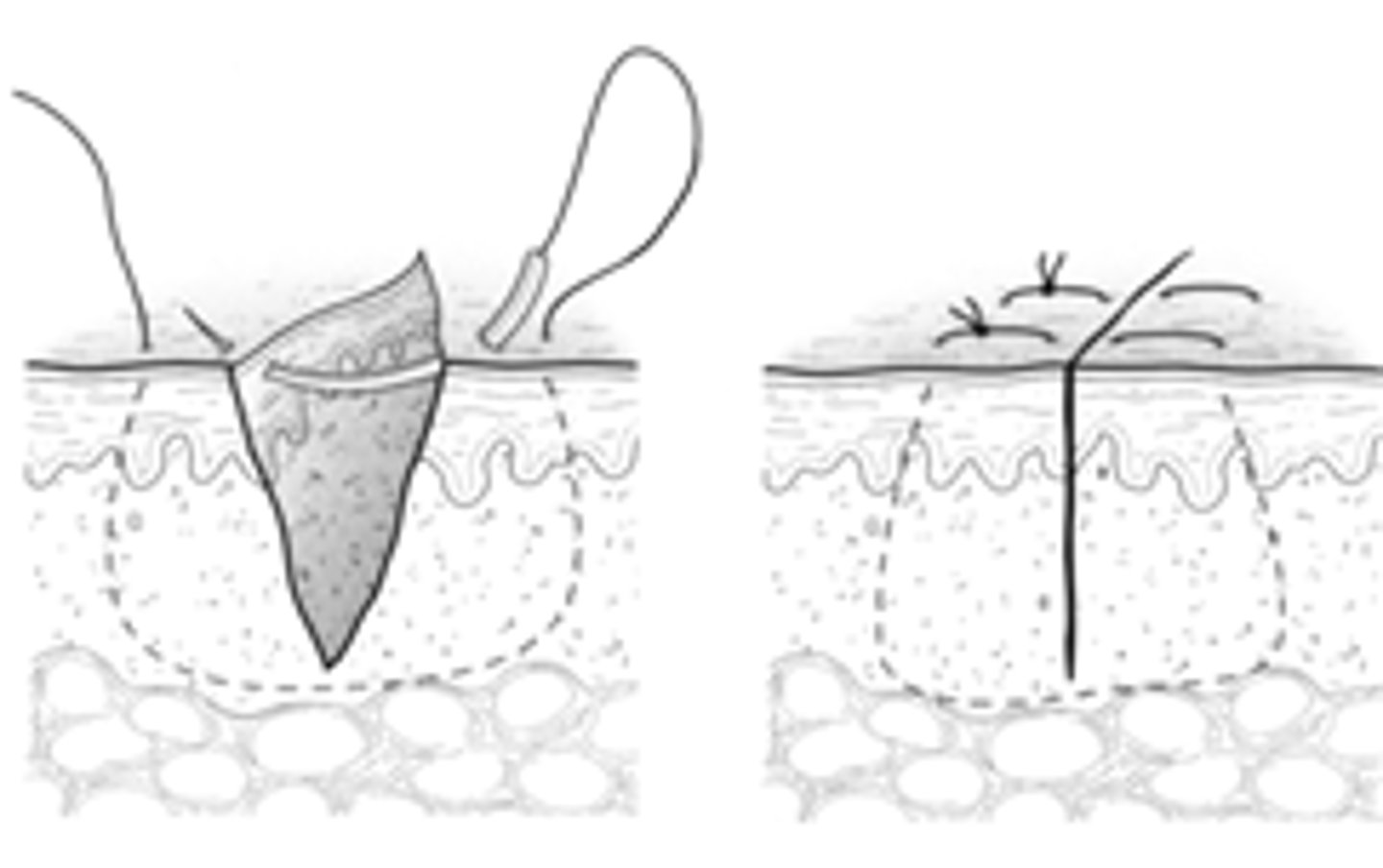 <p>Vertical Mattress</p>