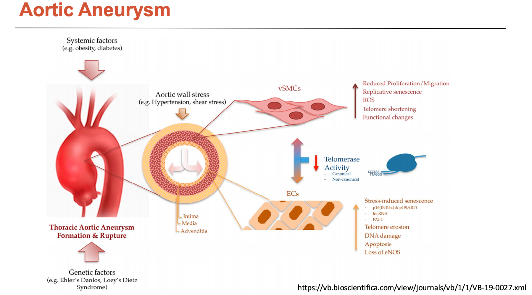 <p>There are two types of aortic aneurysms:</p><ol><li><p><strong>Thoracic aortic aneurysm</strong>: above diaphragm (less prevalent)</p></li><li><p><strong>Abdominal aortic aneurysm:</strong> below diaphragm (more prevalent)</p></li></ol><p>Its pathophysiology involves high BP consequences at a quicker rate:</p><ul><li><p>medial degeneration</p></li><li><p>SMC loss (apoptosis) and contractile to synthetic phenotype switch</p><ul><li><p>increased MMP production</p></li><li><p>cytokine release (e.g. TGF-beta)</p></li></ul></li><li><p>elastic fibre fragmentation</p></li><li><p>disorganised collagen</p></li><li><p>accumulated proteoglycans</p></li></ul><p></p>
