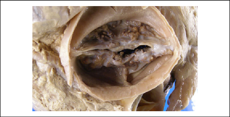 <p>What calcification is this? </p>