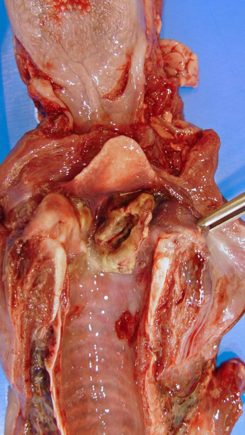 <p>More commonly known as Calf diptheria</p><ul><li><p>Fusobacterium necrophorum</p></li><li><p>Calves</p></li><li><p>C.S</p><ul><li><p>Fever, anorexia, depression</p></li><li><p><u>Halitosis (foul breath)</u>, moist cough, dyspnea</p></li></ul></li><li><p>Lesions</p><ul><li><p>Around the Larynx</p></li></ul></li><li><p>Sequelae</p><ul><li><p>Asphyxiation</p></li><li><p>Pneumonia</p></li><li><p>Sepsis</p></li></ul></li></ul><p></p>
