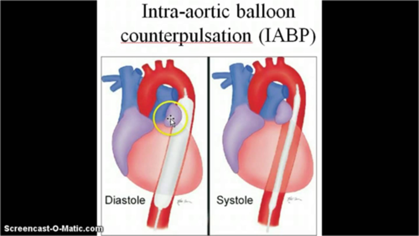 <p>A mechanical assist device that consists of an inflatable balloon pump inserted through the femoral artery into the thoracic aorta. It inflates during diastole to improve coronary circulation and deflates before systole to allow blood ejection from the heart</p>