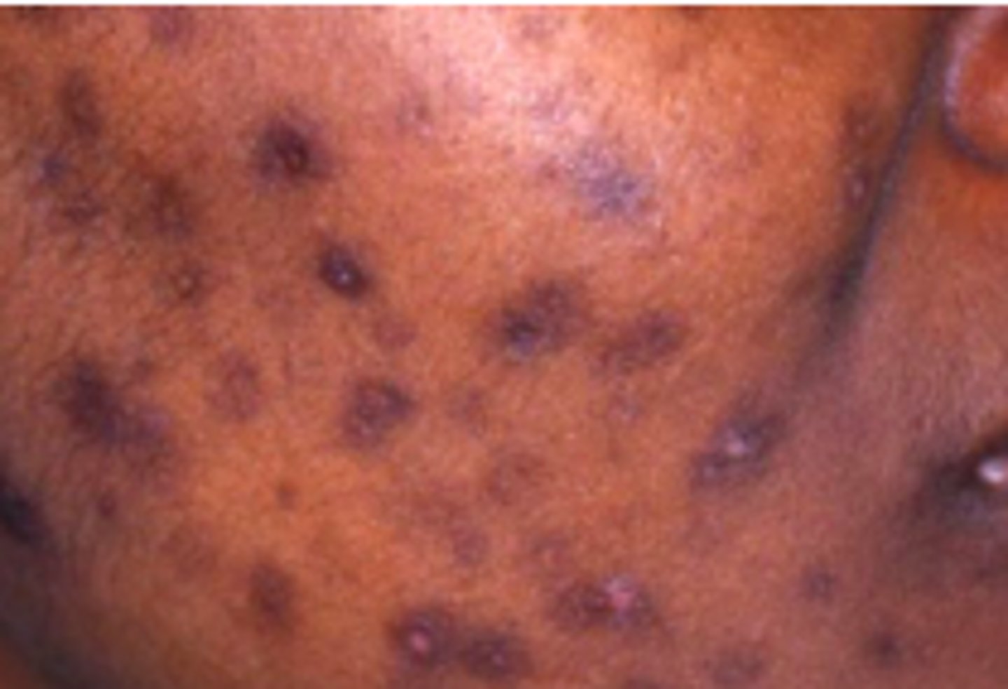 <p>Acneiform Disorders:</p><p>development of hyperpigmentation at site of active/resolving lesion (anytime there’s a break in the dermis and blood touches it)</p>