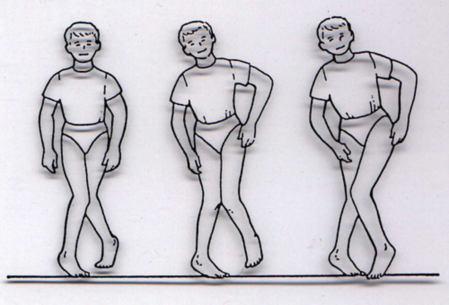 <p>Stiff, short gait; thighs overlap each other with each step.</p><p>Seen with partial paralysis of the legs.</p>